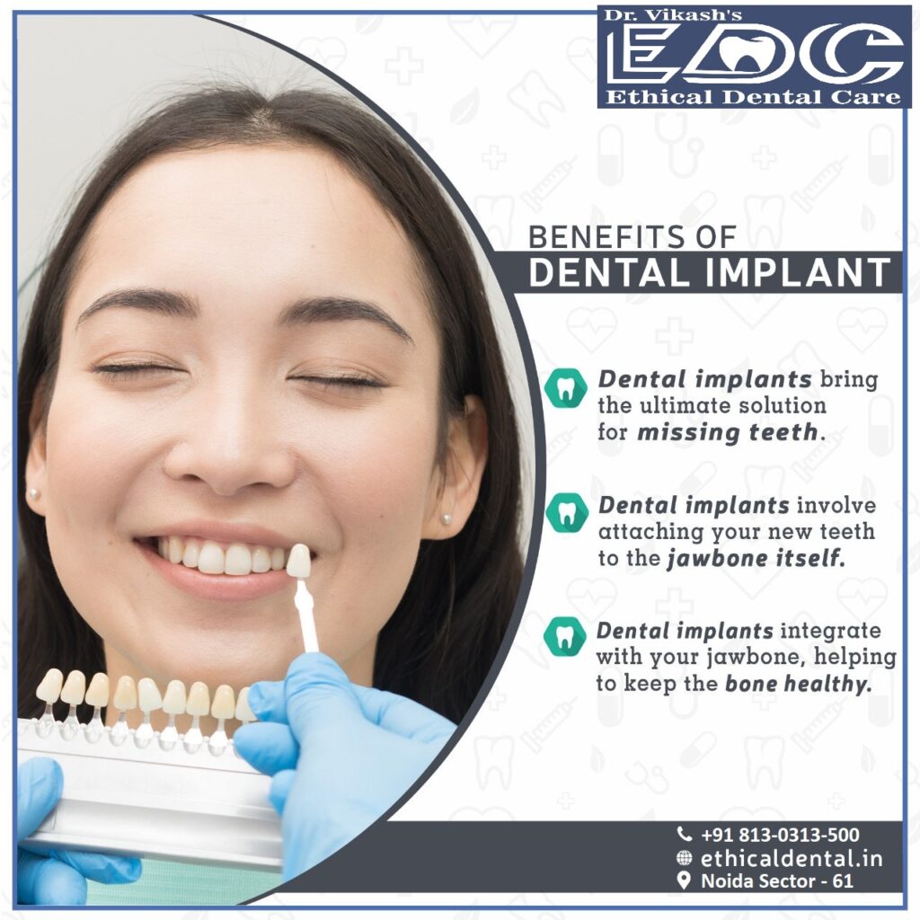 Know About Root Canal Treatment (RCT) V/S Dental Implant