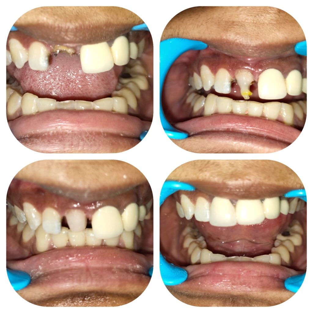Dr. Vikash's Ethical Dental Crown