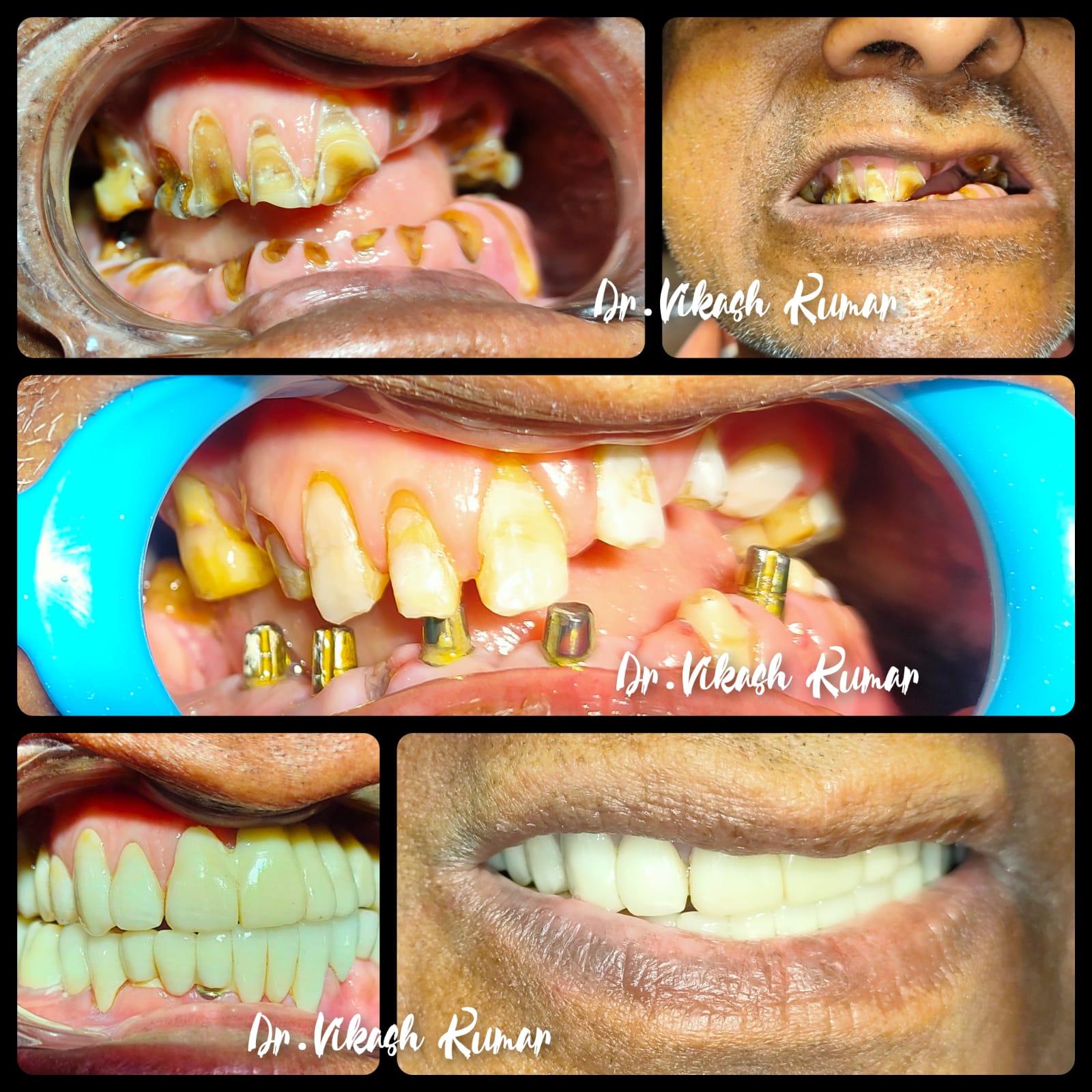 Dr. Vikash Ethical Dental Implant and Crown
