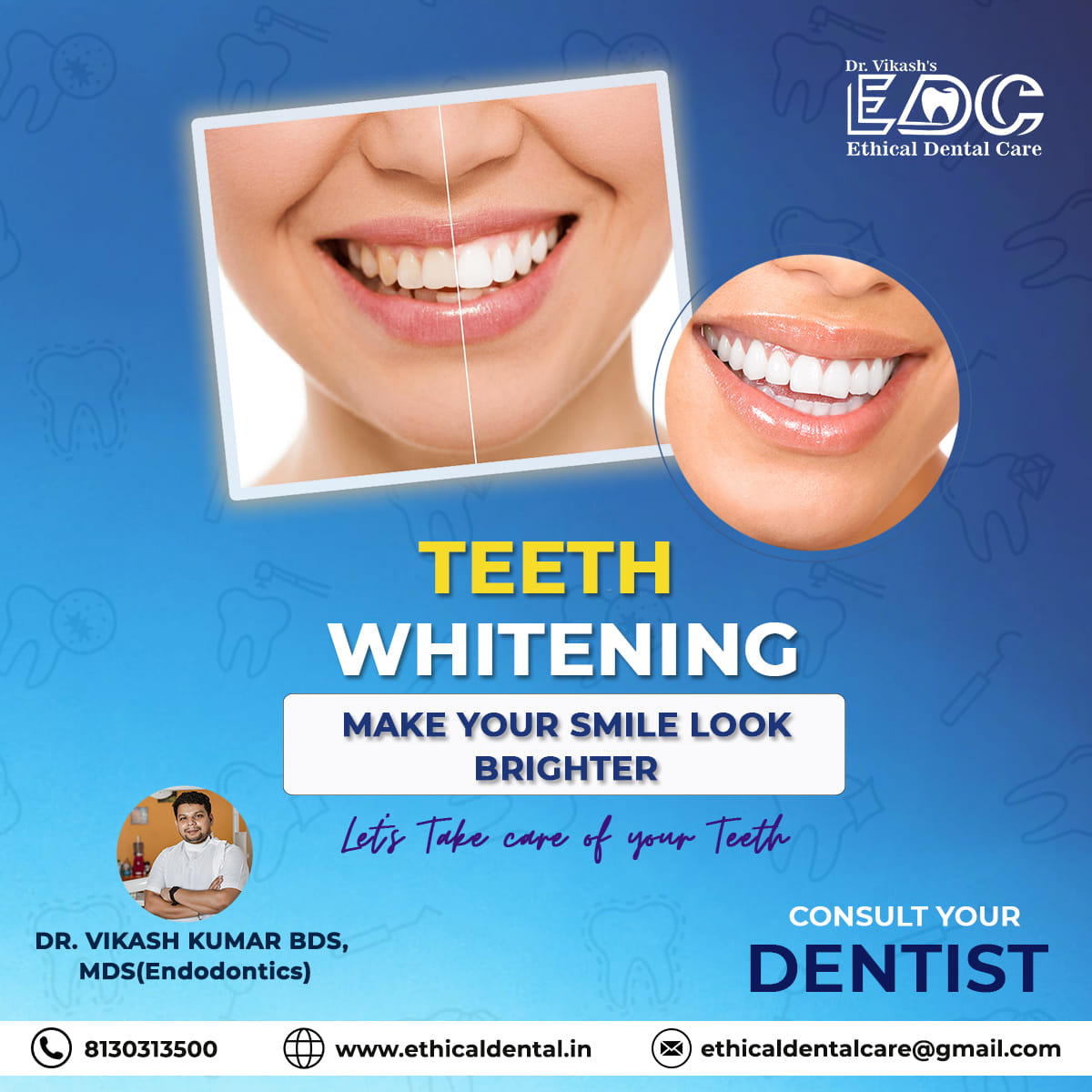 Enhance Your Dental Health Via Tooth Cleaning in Noida