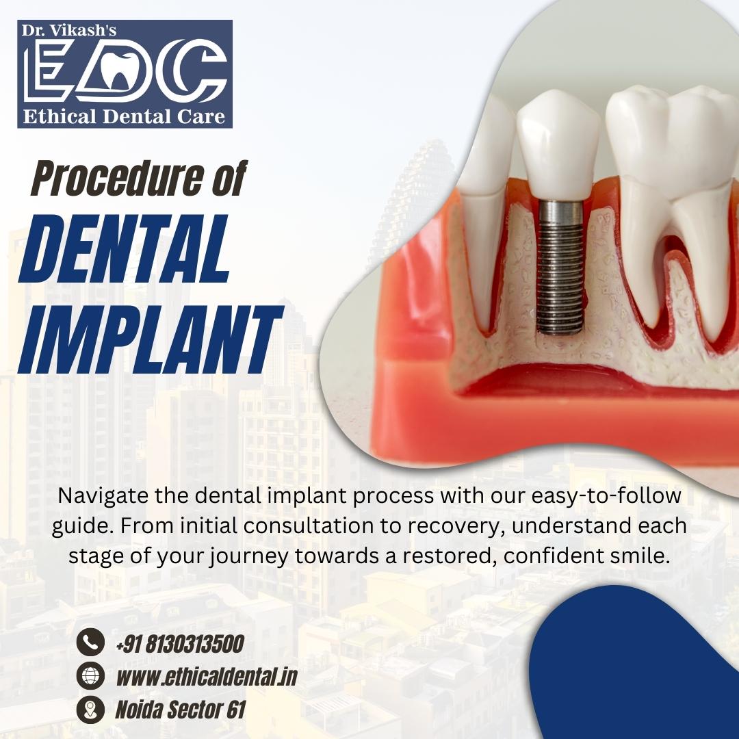 Dental Implant Procedure – Step-by-Step Guide to Restoring Your Smile