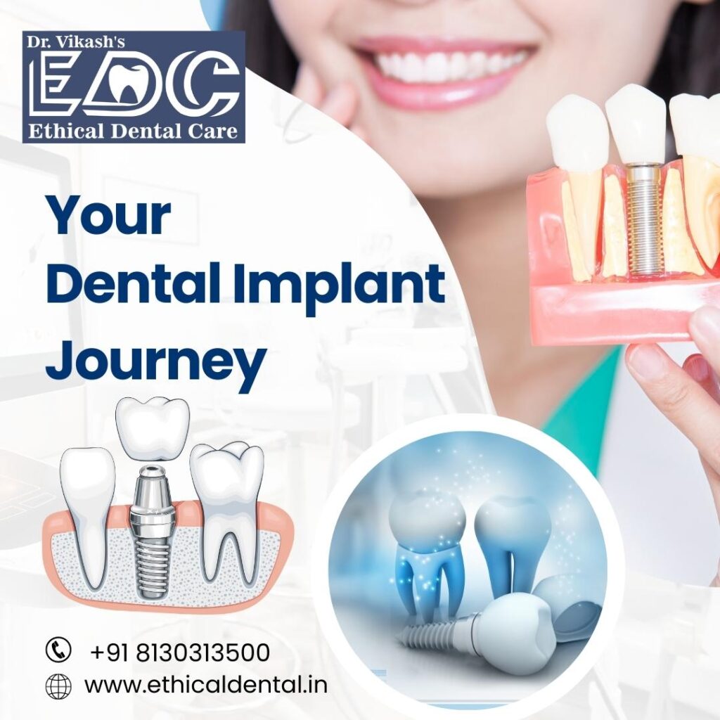 Your Dental Implant Journey: What to Expect During the Procedure