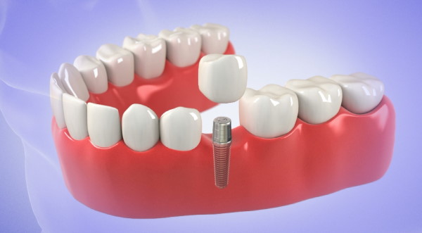 Dental-Implants-One-Day