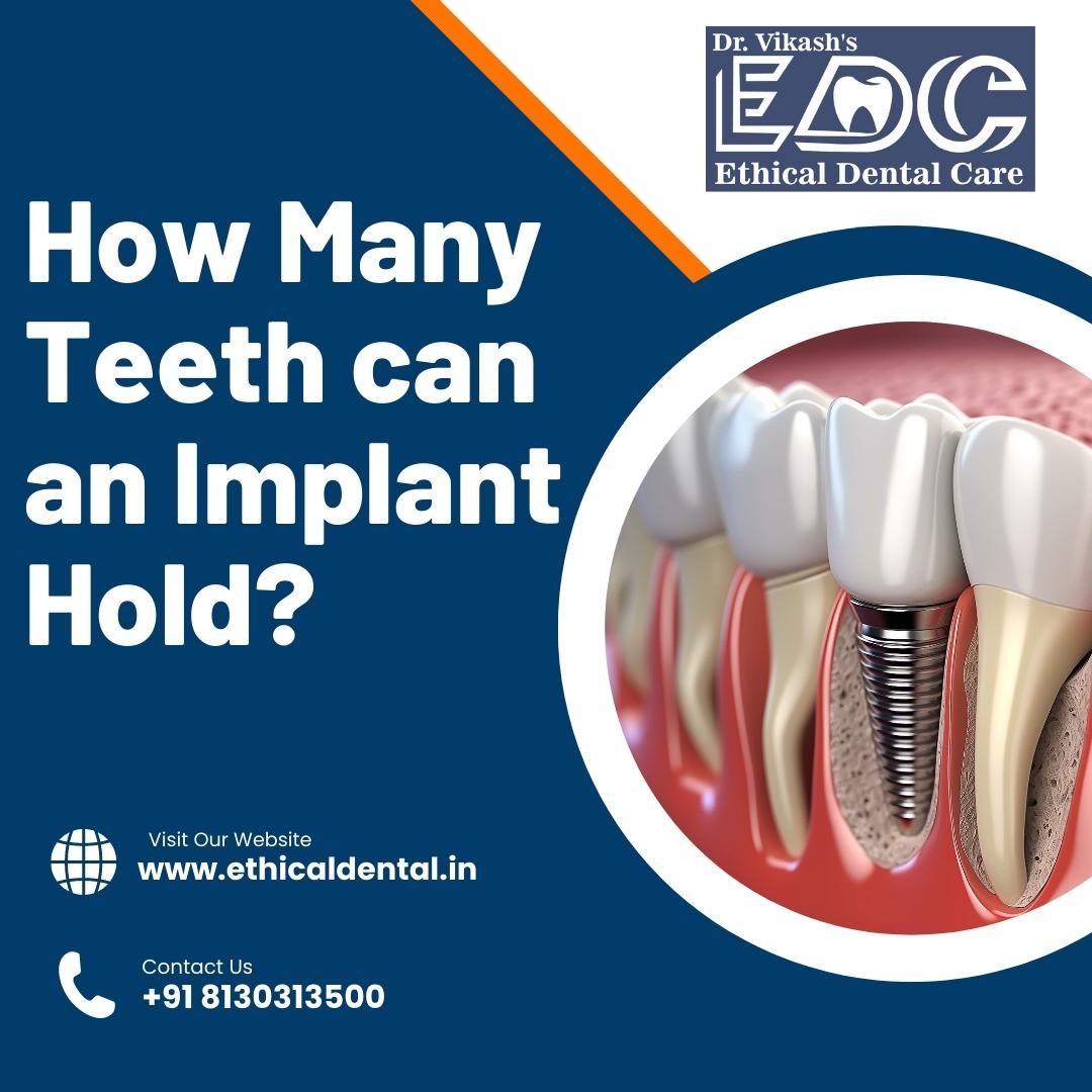 How Many Teeth Can A Dental Implant Hold?