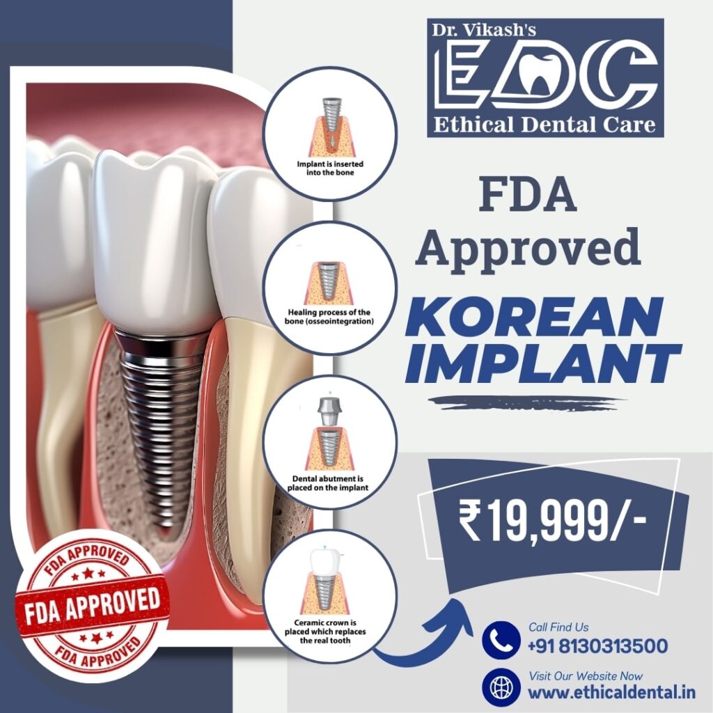 Dental Implants On EMI