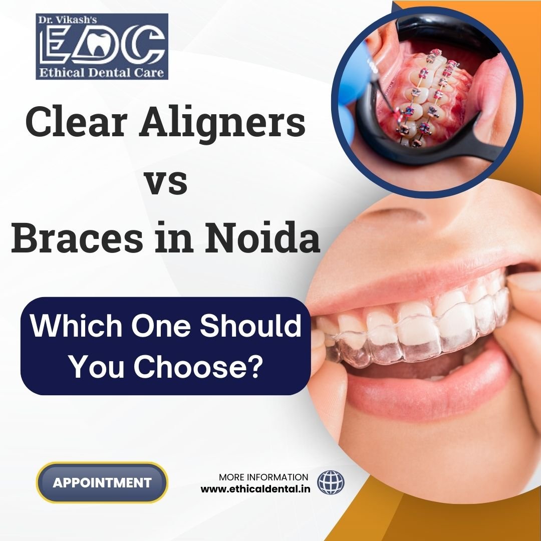 Clear Aligners vs Braces in Noida: Which One Should You Choose?