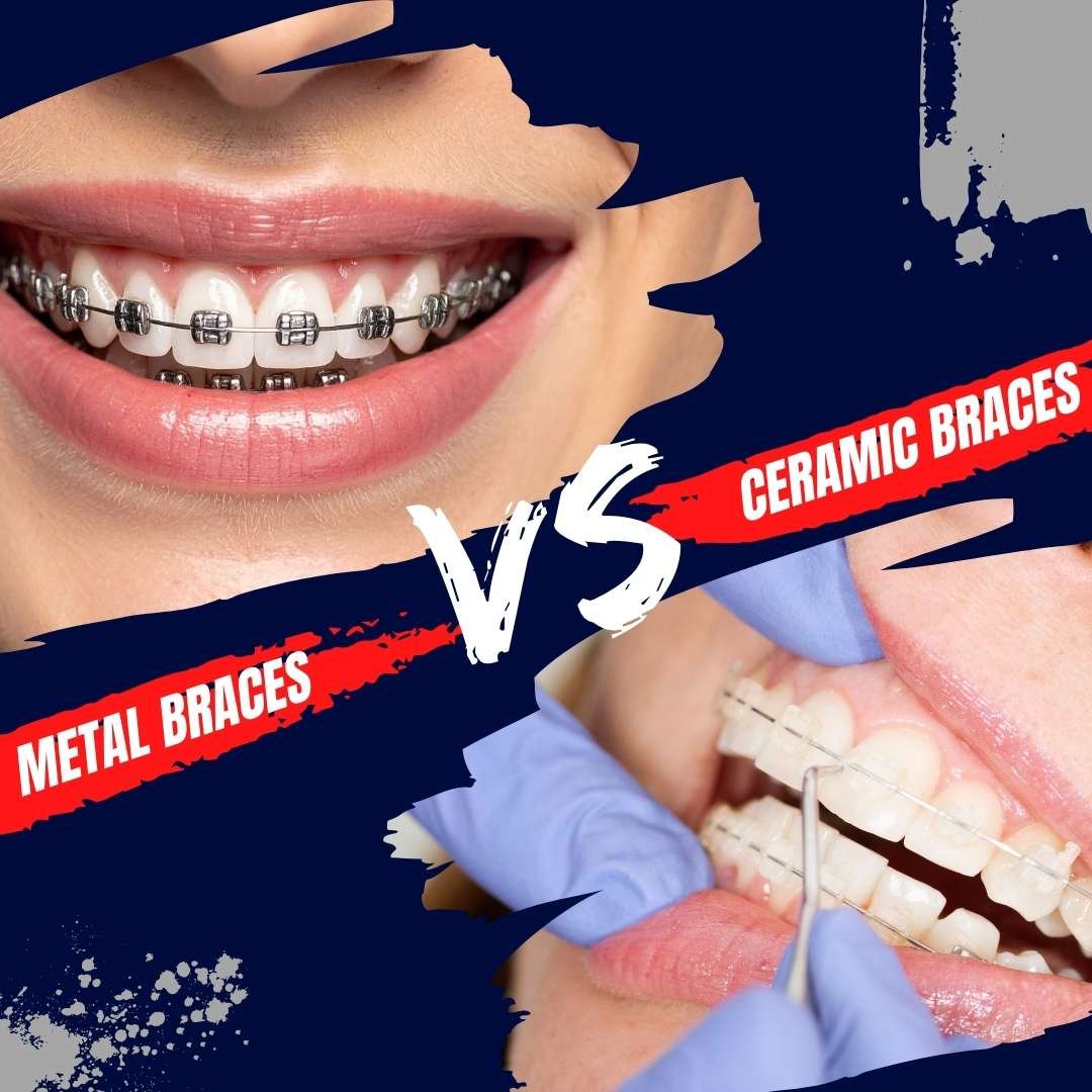 Metal vs Ceramic Braces in Noida – Which Is Right for You?